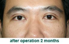 plastic-surgery-blepharoplasty